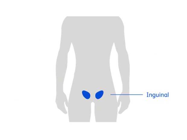 Diagram of a person highlighting groin area showing inguinal hernia location